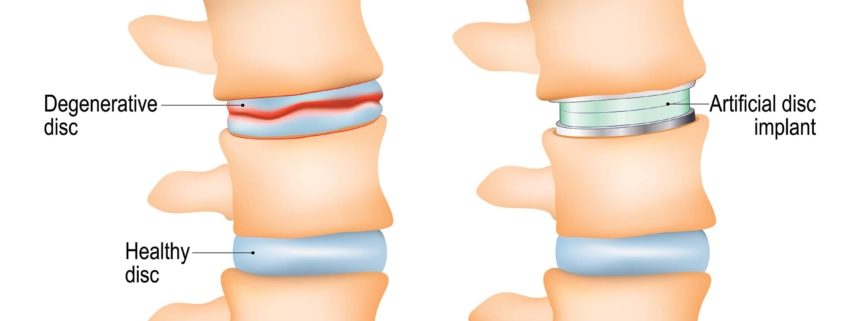 Cervical Disc Replacement Surgery Illustrated
