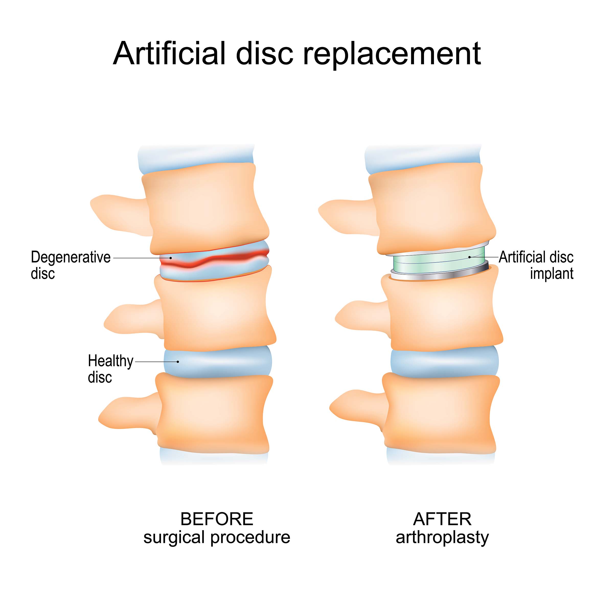 degenerative disc disease car accident settlement marylnmietus